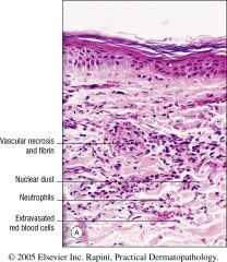 Painful, palpable purpura
Vasculitis w/ neutrophils, eos, lymphocytes, or histiocytes. 
Nuclear dust
Extravasated RBCs
Thrombi sometimes