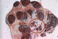 In this placenta, several big cotyledons are evident and these are normal.  In addition, there are some smaller scattered areas where NEW cotyledonary type tissue has formed. Name this occurrence and why does it occur?

Name:
Reason behind it: