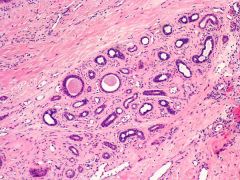 The pictured neoplasm can present in eruptive fashion in which genetic condition?