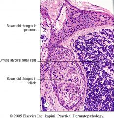CK20 perinuclear dot-like staining
Merkel cell tumor
EMA+
NSE+ 
CD56+