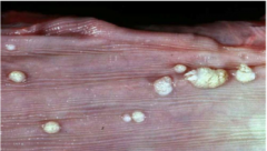 What disease is seen here?


What cellular change is causing these growths?