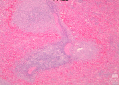 - 3 arterioles (pink areas in center)
- Lymphocytes = pronounced aggregate of small round blue cells surrounding arterioles

* This specimen is from a trauma: RBCs are congesting the red pulp (periphery of PALS) - intensely red areas