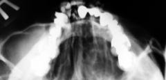 ground glass radiographic appearance (blending at borders with normal bone). No distinct, clear margin (if you see a clear delineation in radiograph, NOT fibrous dysplasia)