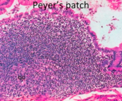 Small Bowel epithelium (bright pink cells)
- Dark blue small lymphocytes are predominantly B cells because it is follicular
- Mantle zone surrounds Germinal Center
