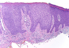 The pictured neoplasm was biopsied out of clinical suspicion for non-melanoma skin cancer. Dx?