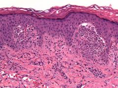 This 36-year-old man has pruritic papules and vesicles of the elbows and shoulders.  Punch biopsy is performed (see image) and direct immunofluorescence (DIF) reveals granular deposition of IgA along the epidermal basement membrane.  The other fin...