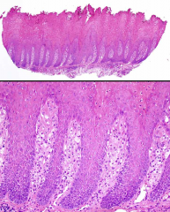 Bx was taken from the lip of a 46-year-old man.  In which syndrome can you see similar lesions?