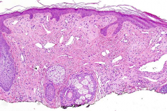 The following lesion is found in a patient with tuberous sclerosis.