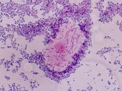 Clue cells are epithelial cells covered in bacteria. Often observed with Gardnerella vaginalis infections.