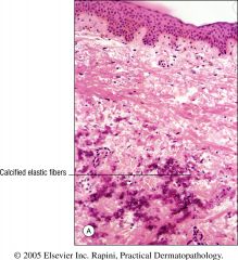 Pseudoxanthoma elasticum is an inherited elastic tissue disorder due gene defect on chrom 16 w/ grouped, pseudoxanthomatous yellowish papules in flexural areas.   
Calcification of elastic fibers occurs, leading to laxity of the skin and vessel w...