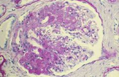 1. This accounts for 25% of the cases of nephrotic syndrome in adults and is more common in blacks. Hematuria and HTN are often present
2. It has a fair to poor prognosis. It is generally resistant to steroid therapy- patients develop renal insuf...