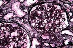 1. usually presents with nephrotic syndrome, glomerular capillary walls are thickened
2. Primary disease is idiopathic. The secondary form is due to infection (hepatitis C, hepatitis B, syphilis, malaria), drugs (gold, captopril, penicillamine), ...