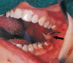 Abscess  


An intraoral abscess has been incised, and a drain placed to allow the escape of purulent exudate from the tissue.