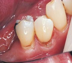 Abrasion 


 


Most frequently seen as a notching on root surfaces with gingival recession