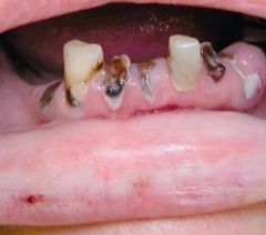 the extensive and rapid destruction of the teeth  due to methamphetamine abuse