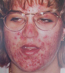1.  Chronic inflammation of the pilosebaceous units of skin
