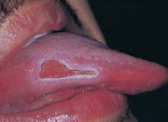 Occurs as a result of some form of trauma
Cheek, lip, or tongue biting
Denture irritation
Mucosal injury
Overzealous Brushing