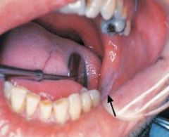 Cased by chronic rubbing or friction against an oral mucosal surface; resembles a callus on skin