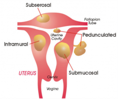 SUBMUCOSAL. 

Submucosal myomas are most likely to cause infertility. Presumed mechanisms include: 1) focal endometrial vascular disturbance; 2) endometrial inflammation, and; 3) secretion of vasoactive substances. Submucosal fibroids are best t...