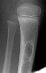 ? False


It is described as a mildly expansile lesion but not to the extent of an anuerysmal bone cyst