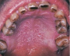 A benign lesion typically associated with pipe and/or cigar smoking and may also occur with cigarette smoking