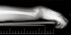 False


According to the classification of distal radius fractures, an intra-articular fracture of the distal radius is called a Barton's fracture