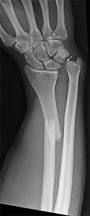 Distal radial shaft fracture with distal radio-ulnar joint dislocation