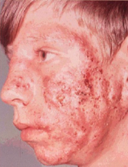 1.  Severe variant of acne
2.  Large, multiple comedones, abscesses, sinus tracts