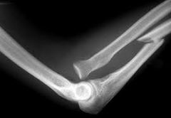 A proximal ulna shaft fracture with radial head dislocation
