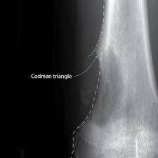 True or false: Ewing's sarcoma is characterized by perostial reaction known as Codman's triangle, because the fast growing tumour lifts off the periosteum in this manner