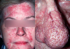 1.  Chronic inflammatory dermatologic disorder
2.  Redness w/ pustules, papules, telangiectasia, and hypertrophy of sebaceous glands