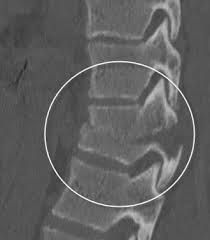 False


A chance fracture is defined as a pure bony injury extending from posterior to anterior through the spinous processes, pedicles and vertebral bodies respectively. By definition the posterior elements are not intact, thus this is not a chan...