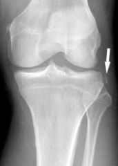 False 


A segond lesion is an avulsion fracture on the lateral side of the tibial plateau and is indicative of an ACL injury
