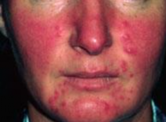 1.  Papules and pustules begin
2.  Increased erythema and telangiectasias