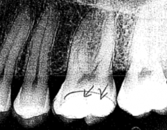 1. Identify the radiolucent structure in the upper right area.


2. Describe the radiograph in terms of area, restorations, and apparent periodontal health.