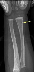 A compression fold of the junction between metaphysis and diaphysis in children
