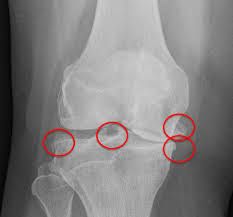 Osseous outgrowth in response to micro instability of a joint, it is a stabilizing response