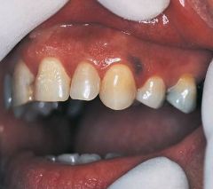 Normal physiologic pigmentation of the oral mucosa. 