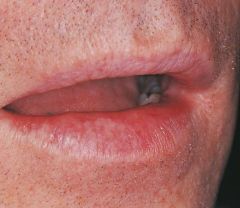 a degeneration of the tissue of the lips, caused by exposure to the sun