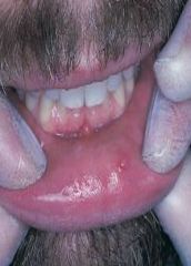 a lesion that forms when a salivary gland secretion spills into the adjacent connective tissue


 


not lined with epithelium