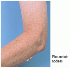Subcutaneous nodules may develop at pressure points along the extensor surface of the ulna 

Firm and nontender, not attached to the overlying skin

May occur near olecranon bursa or more distally