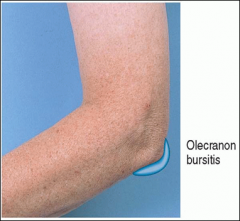 Swelling and inflammation of the olecranon bursa 

May result from trauma or may be associated with rheumatoid or gouty arthritis.

Superficial to olecranon process
