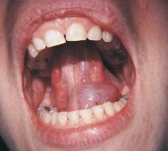a larger mucocele-like lesion that forms unilaterally on the floor of the mouth