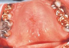a benign condition of salivary glands characterized by moderately painful swelling and ulceration


affects the tissue at the junction of the hard and soft palate


loss of blood supply to salivary gland