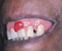 a commonly occurring intraoral lesion that is characterized by a proliferation of connective tissue
occurs in response to injury
soft and bleeds easily