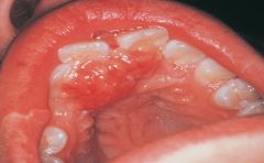 a common exophytic gingival lesion that can clinically resemble an irritation fibroma