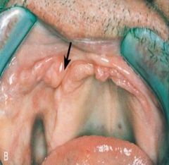 caused by an ill-fitting denture
generally located in the vestibule along the denture flange
made of fibrous connective tissue

 