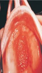 Denture-induced
associated with fungal infection