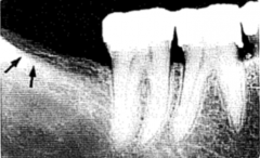 1. What structure is indicated by the black arrows?


2. Describe radiograph by type and location.