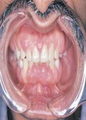 characterized by an increase in the size of the marginal an attached gingiva usually involving the interdental papillae